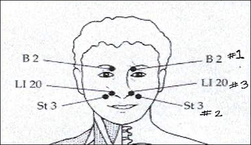 Sinus Trigger Points